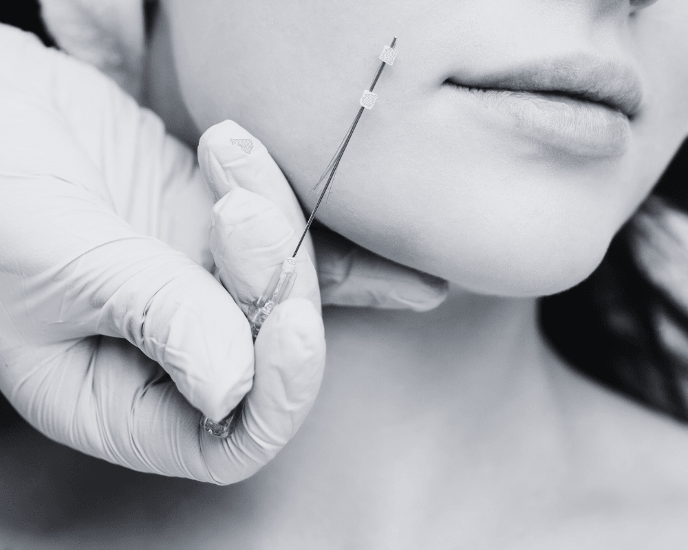 Thread Lifts with PDO Threads: The Modern Solution to Ageless Beauty - Age To Perfection