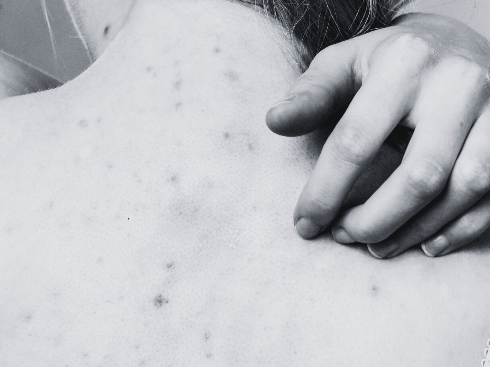 Unlocking the Secrets to Clear Skin: Your Personalized Path to Acne-Free Radiance - Age To Perfection