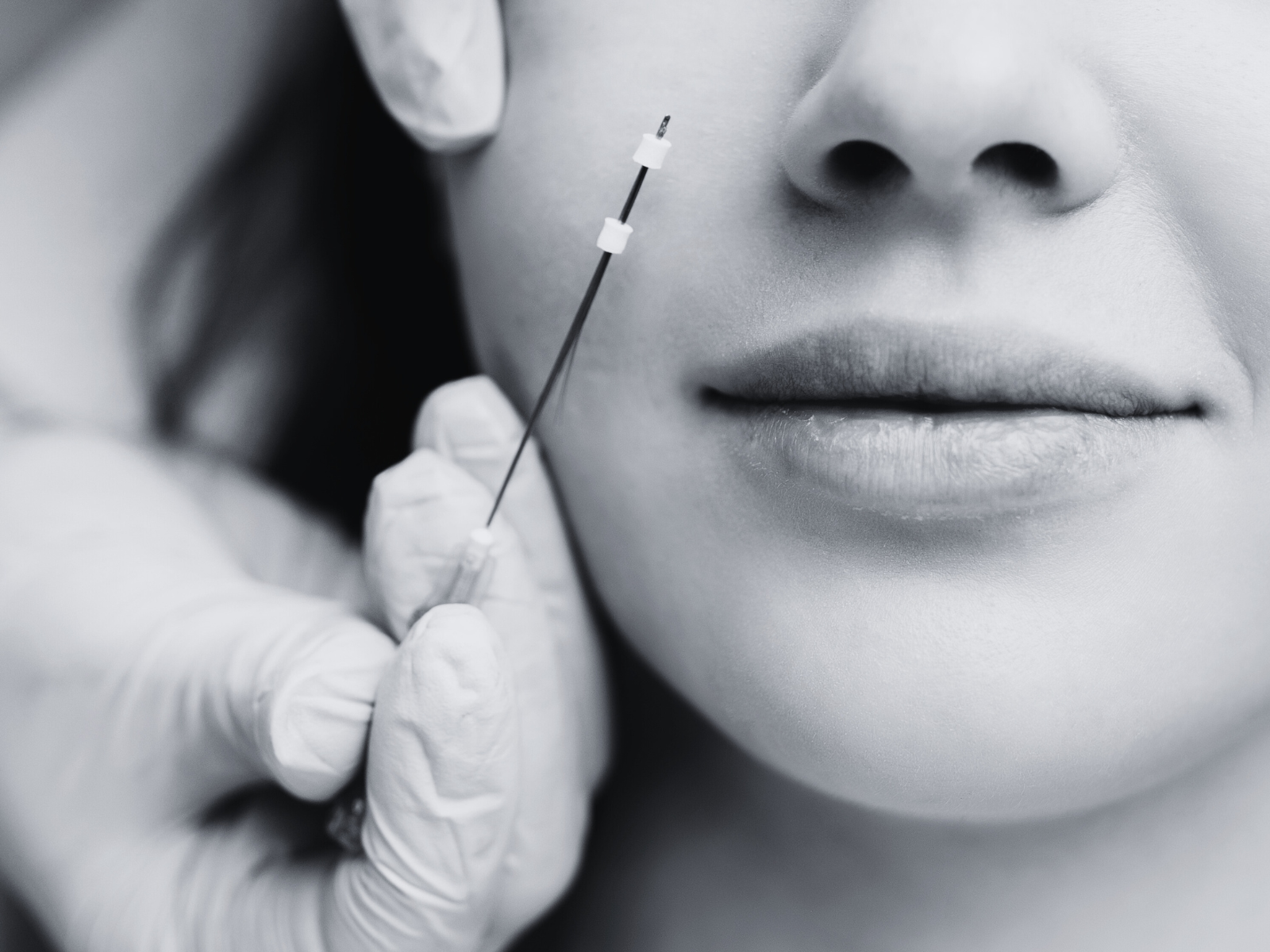 The Minimally Invasive Path to Ageless Beauty with PDO Threads