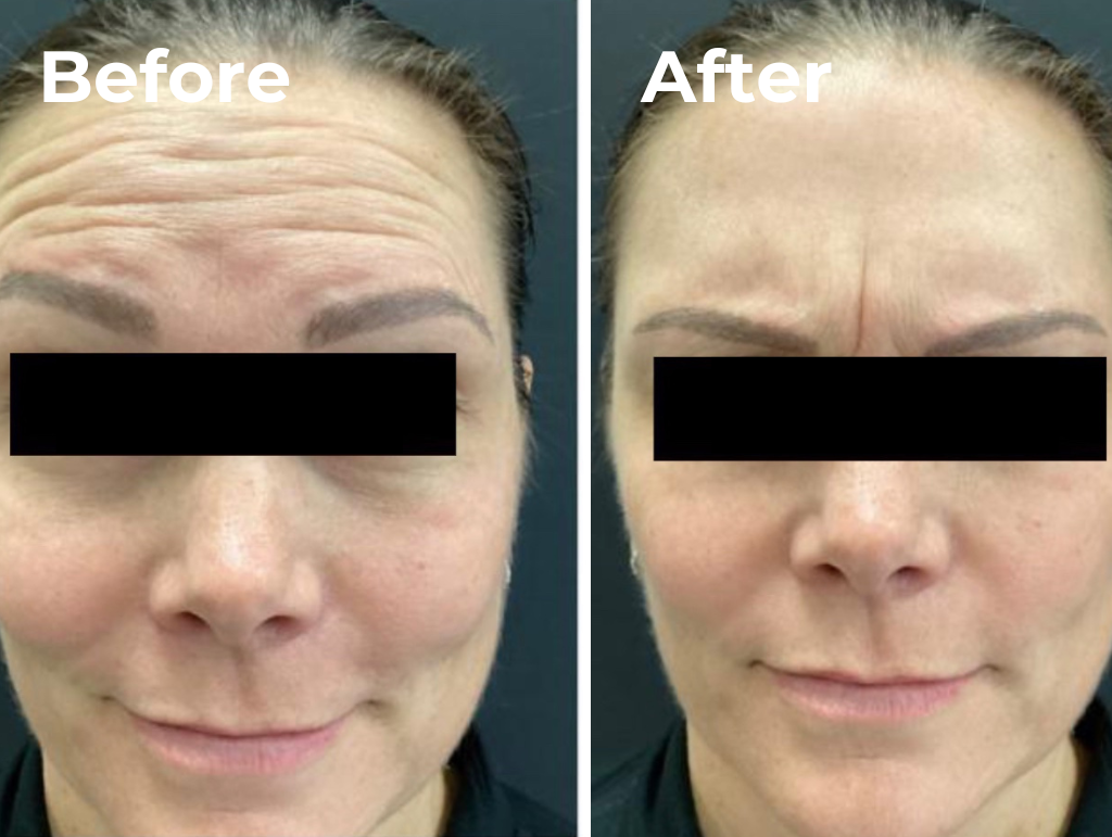 Before & After Wrinkle Relaxer